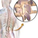 Low Cost Spinal Fusion Surgery in India