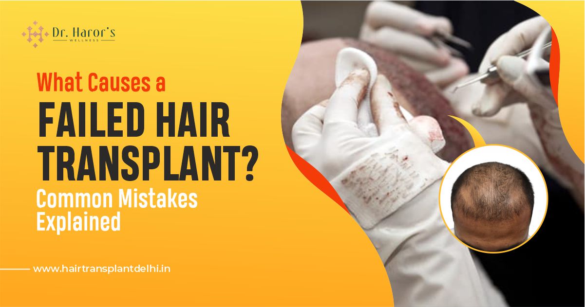 What Causes a Failed Hair Transplant Common Mistakes Explained