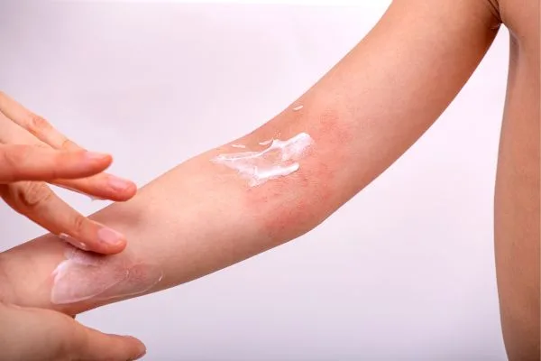 Allergic Dermatitis Treatment (1)