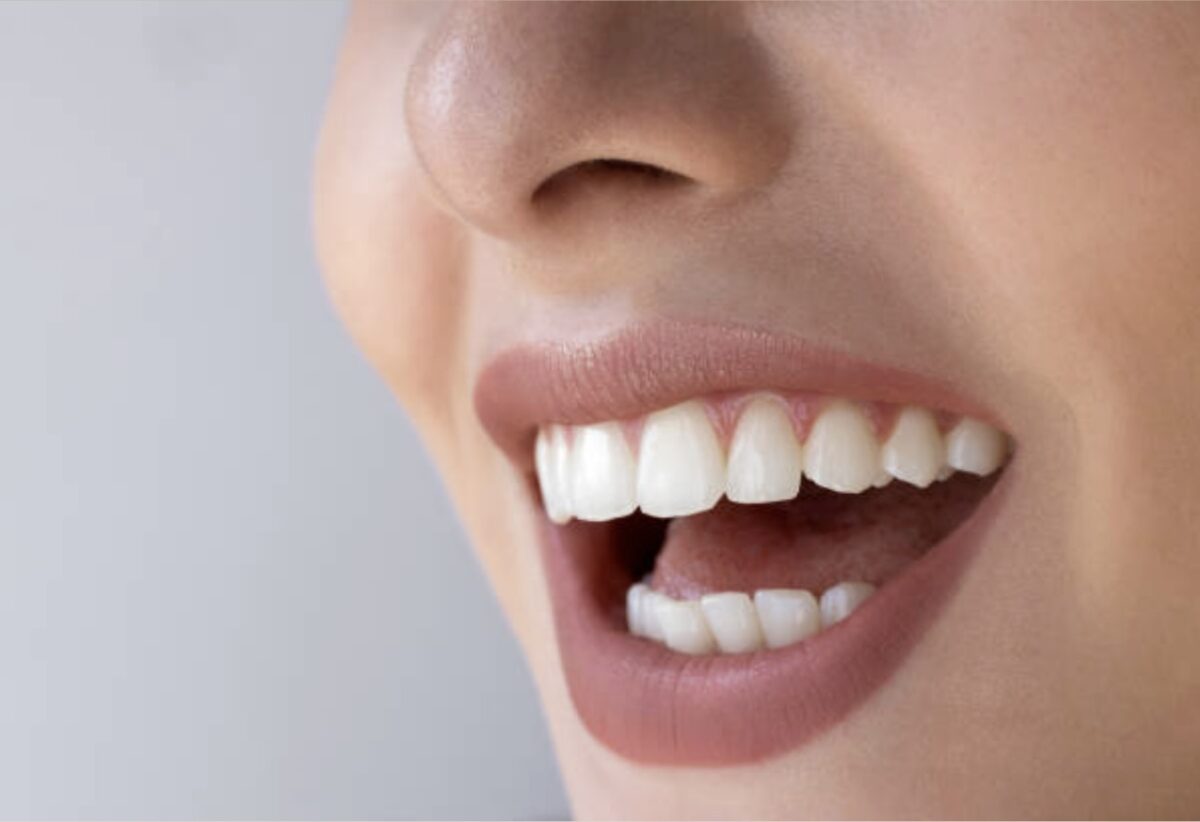 Tooth Color Fillings in Mount Roskill, Auckland