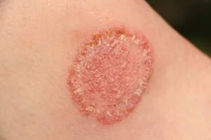 Skin Fungal Infection Treatment
