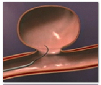 Endovascular_Coiling