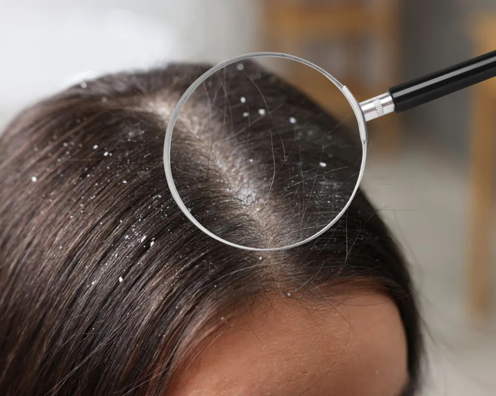 Dandruff-Treatment- (1)