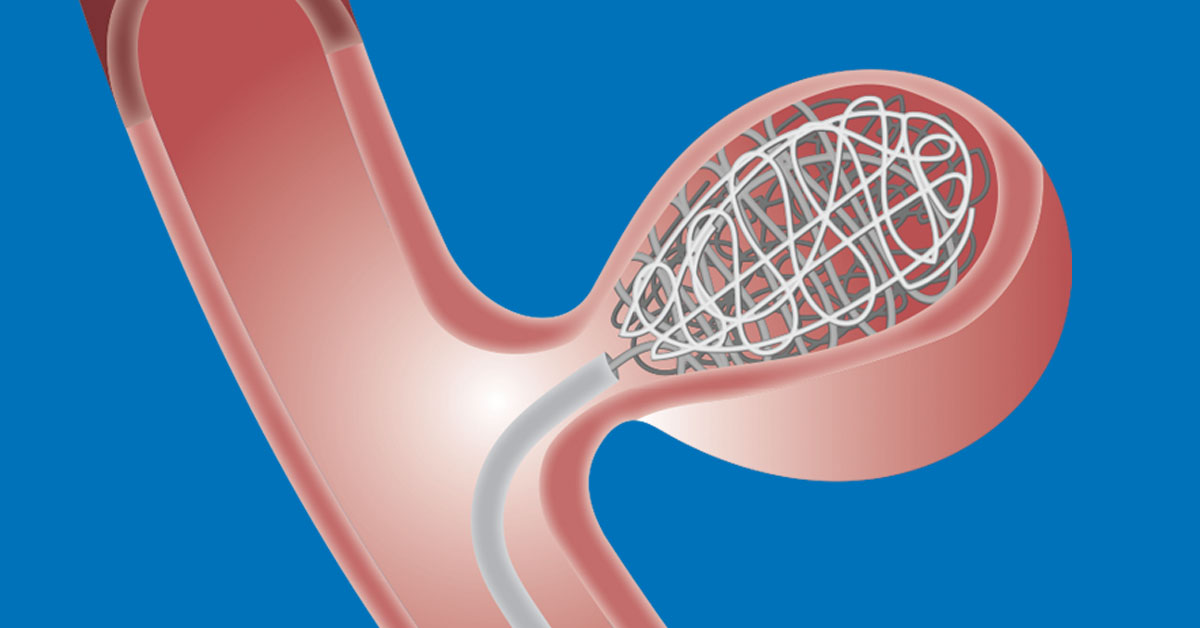 Coil-Embolization-for-Brain