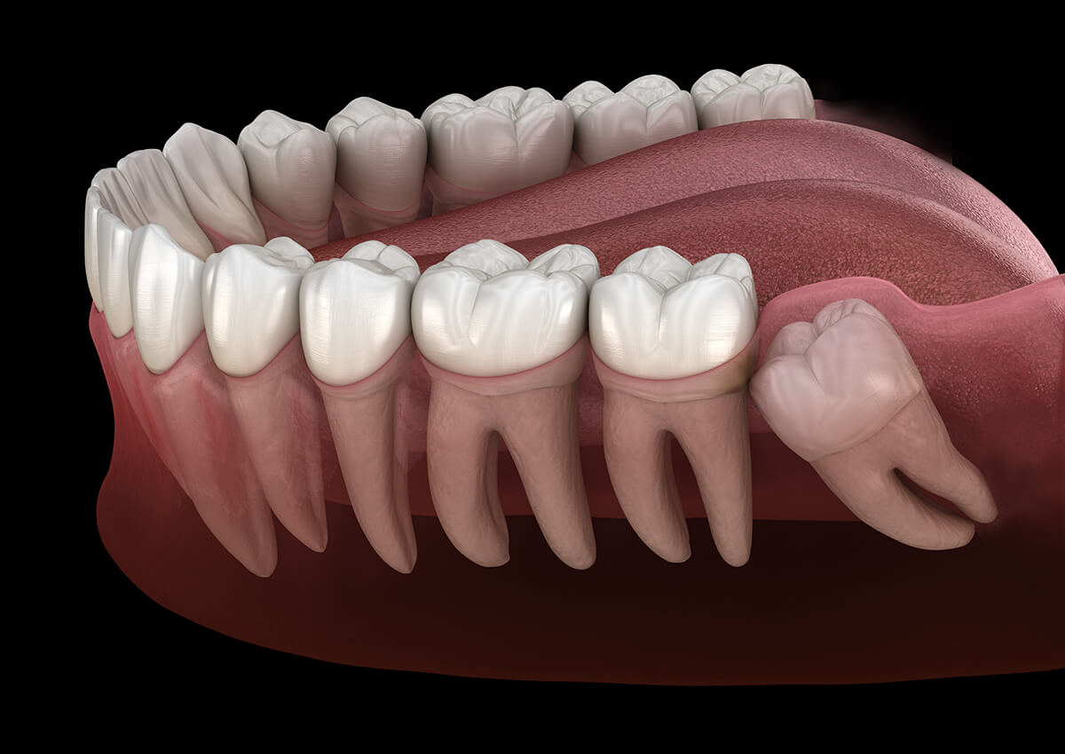 Wisdom-Teeth-Removal