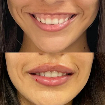 lip-flip