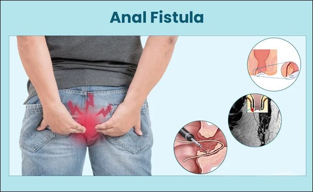 Piles and Fistula Treatment