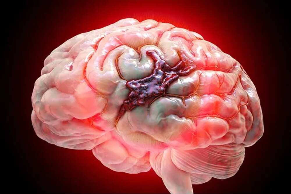 What_is_a_Brain_Hemorrhage