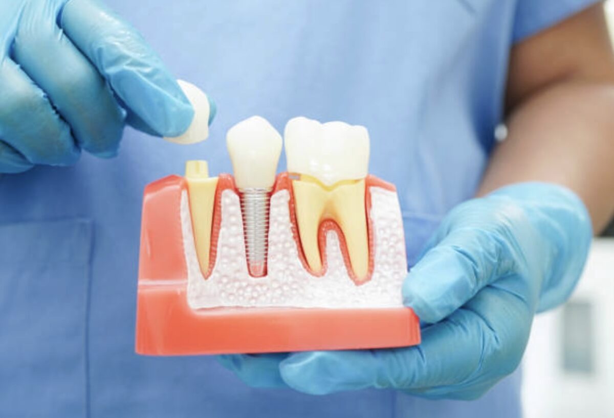 Dental Crowns in Mount Roskill, Auckland