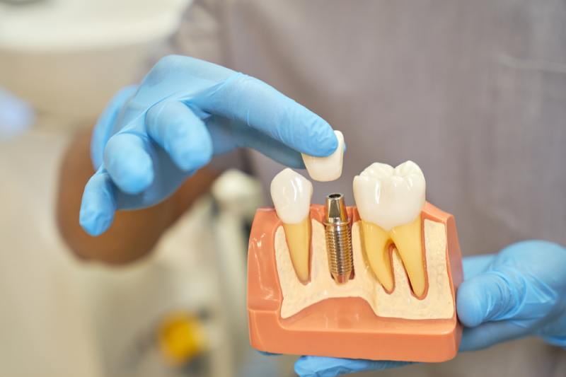 plastic-prop-teeth-implant-being-shown-by-dentist-1