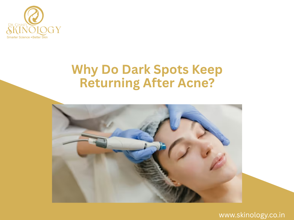 Why Do Dark Spots Keep Returning After Acne