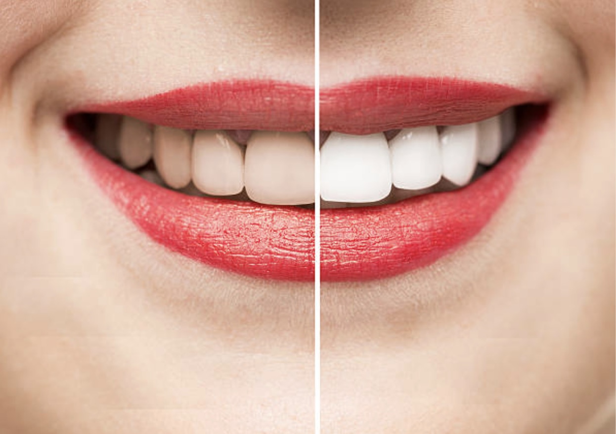 Teeth Whitening in Mount Roskill, Auckland