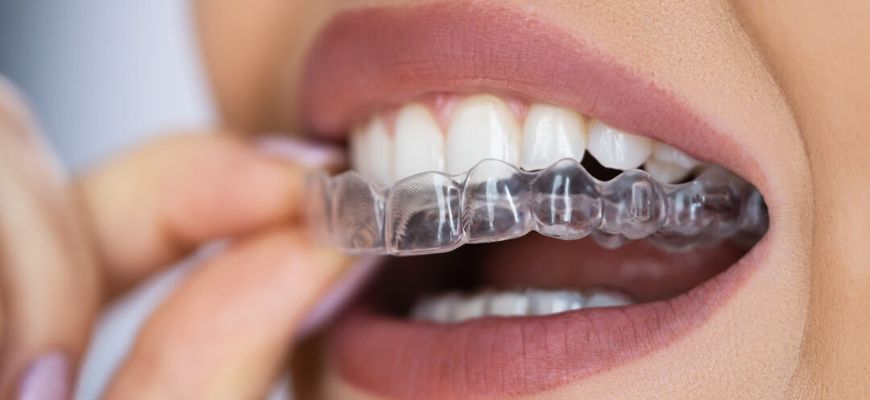 Invisible Braces
