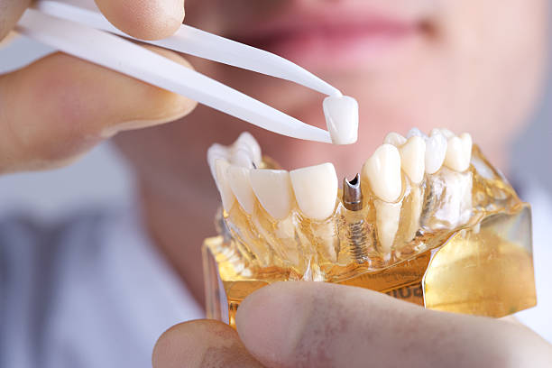 How-Painful-is-a-Dental-Implant-REALLY_