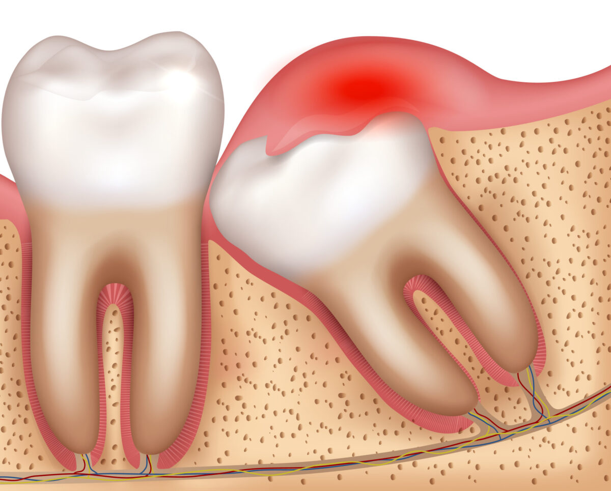 Wisdom Tooth