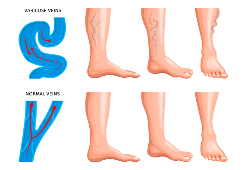 Varicose Veins Treatment