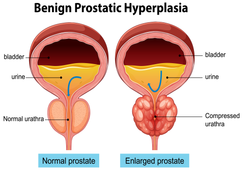 Enlarged Prostate